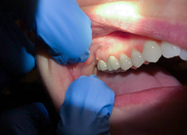 Best Emergency Tooth Extraction in Lena, IL